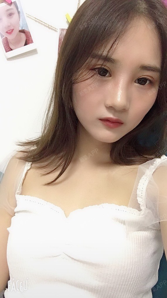 玻尿酸去黑眼圈好不好_效果图_安安anan玻尿酸去黑术5