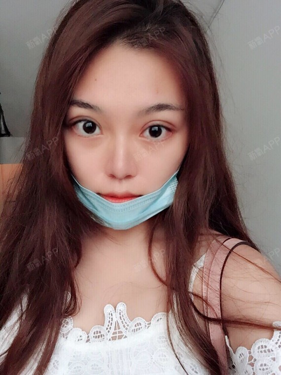 【美好尉来医美切开双眼皮 肌力加强 下至