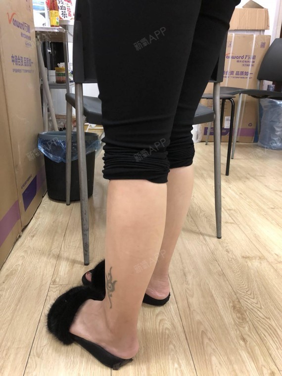 没有瘦脸的大医院肉户口瘦毒素第30天美表姐同济哪家针丽日好S打南昌小腿求诊图片