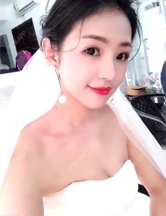 么么露鼻综合第535天美丽日记-新氧美容整形