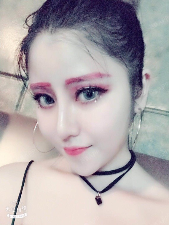 啉琳之恋肋软骨隆鼻第113天美丽日记-新氧美容