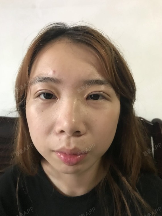 小秦子切开双眼皮第7天美丽日记-新氧美容整形