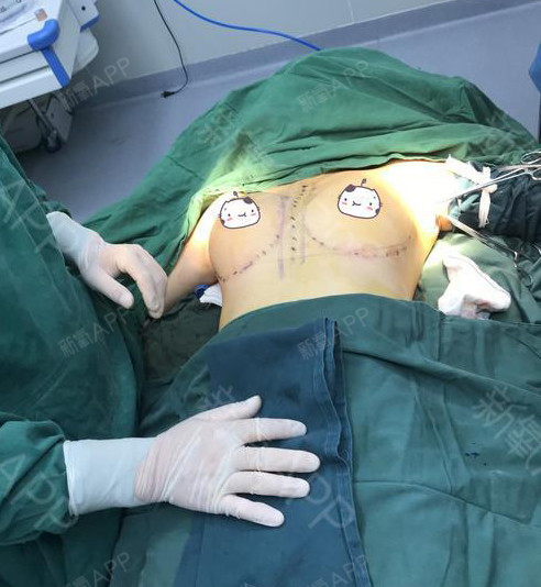 NoaGaya假体隆胸第0天美丽日记-新氧美容整形