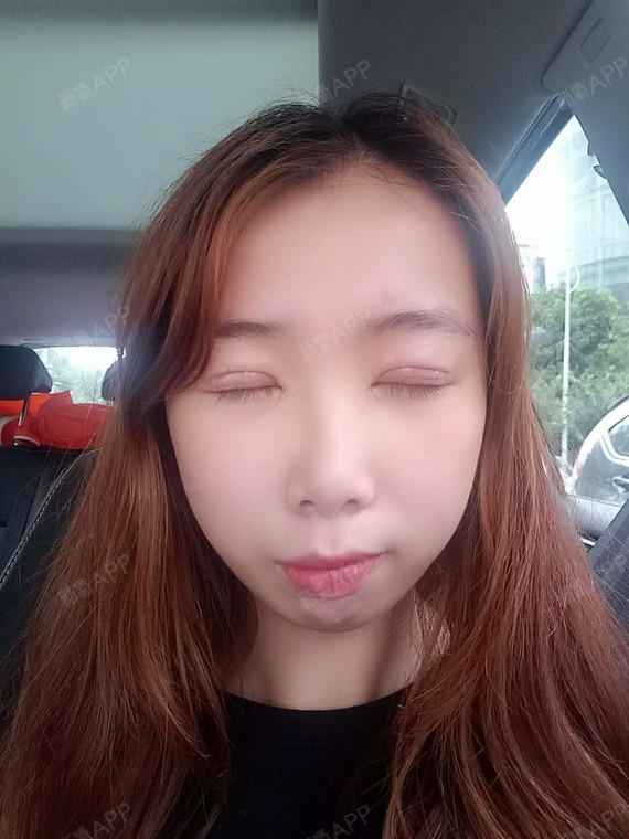 小秦子切开双眼皮第8天美丽日记-新氧美容整形