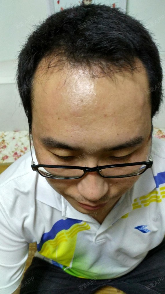 龙争虎斗种植发际线第77天美丽日记-新氧美容