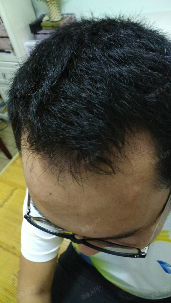 龙争虎斗种植发际线第77天美丽日记-新氧美容