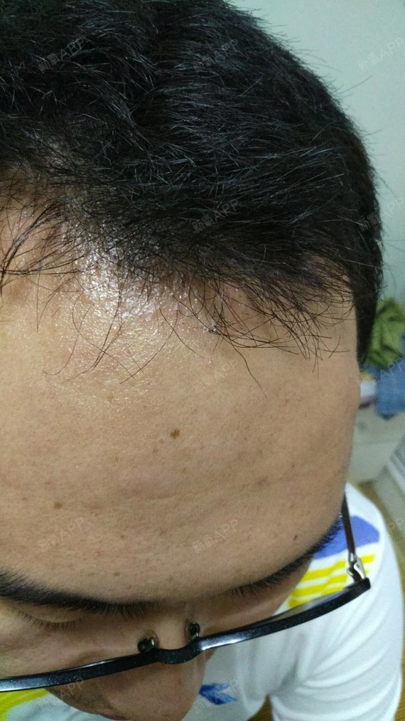 龙争虎斗种植发际线第77天美丽日记-新氧美容