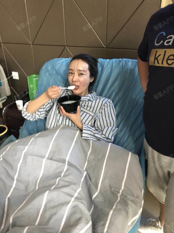 飞鱼y自体脂肪丰额头第1天美丽日记-新氧美容