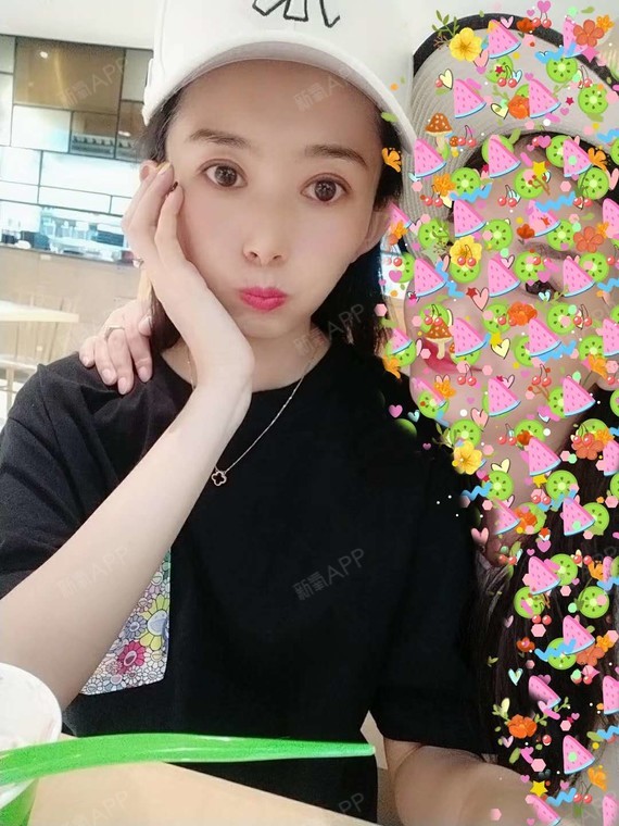 太原丽都整形美容医院切开双眼皮第185天美丽