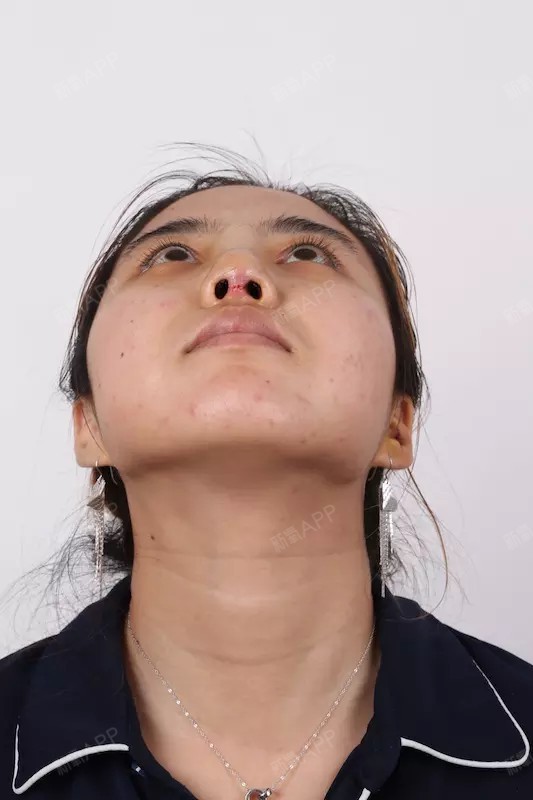 babybabybody手术缩鼻头第7天美丽日记-新氧