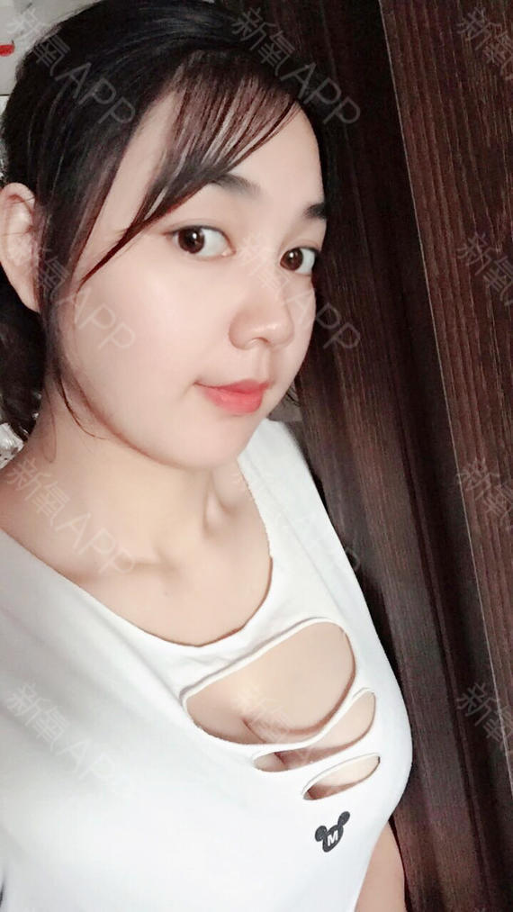 假体隆胸第31天