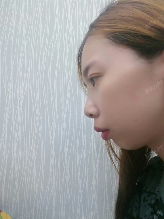 小秦子切开双眼皮第10天美丽日记-新氧美容整