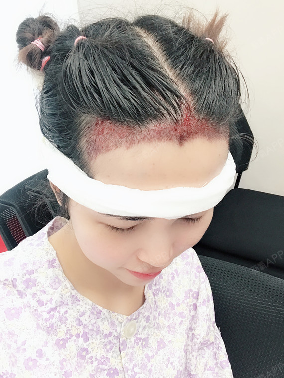 15172164756978.code.monkey种植发际线第0