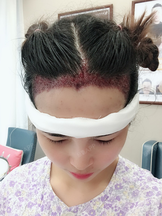 15172164756978.code.monkey种植发际线第0