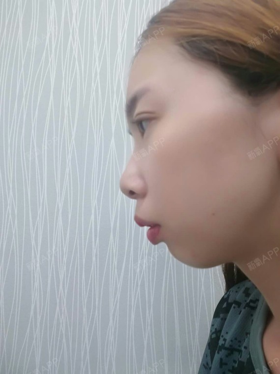 小秦子切开双眼皮第10天美丽日记-新氧美容整