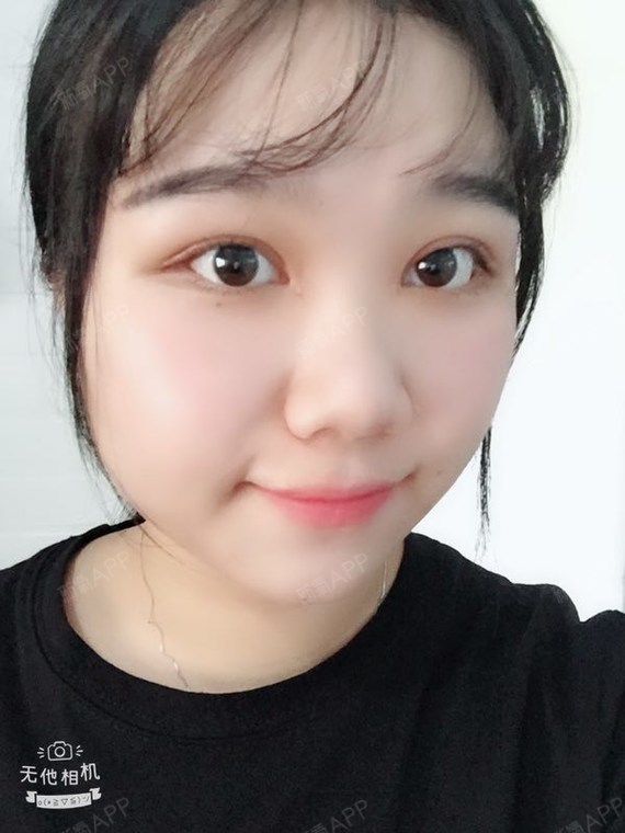 阿尔法的猫切开双眼皮第100天美丽日记-新氧美