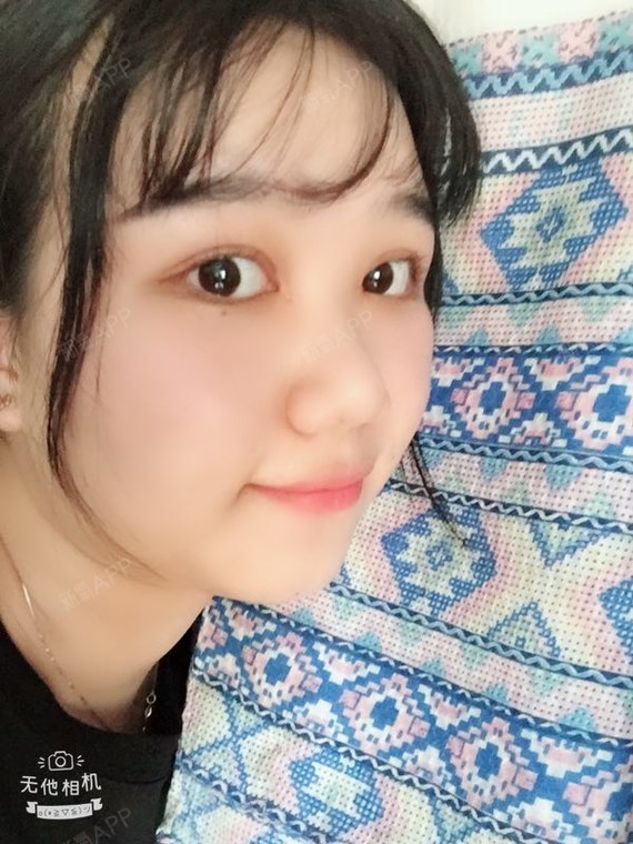 阿尔法的猫切开双眼皮第100天美丽日记-新氧美