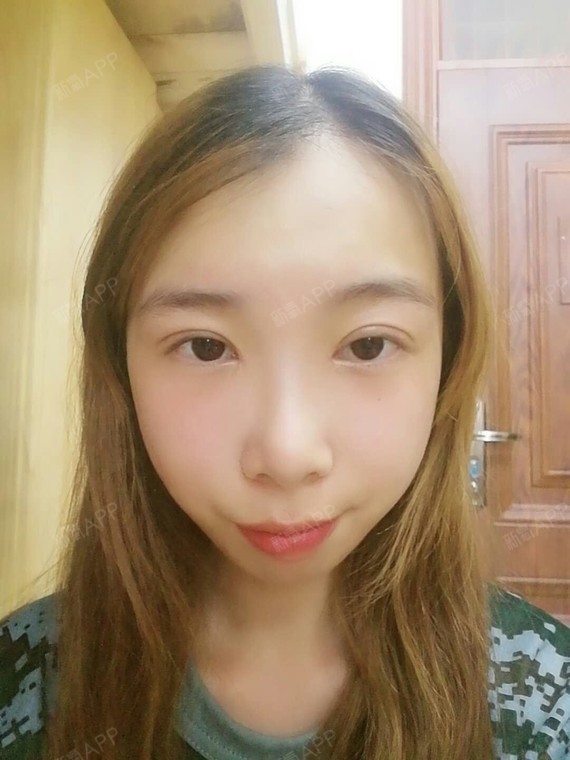 小秦子切开双眼皮第11天美丽日记-新氧美容整