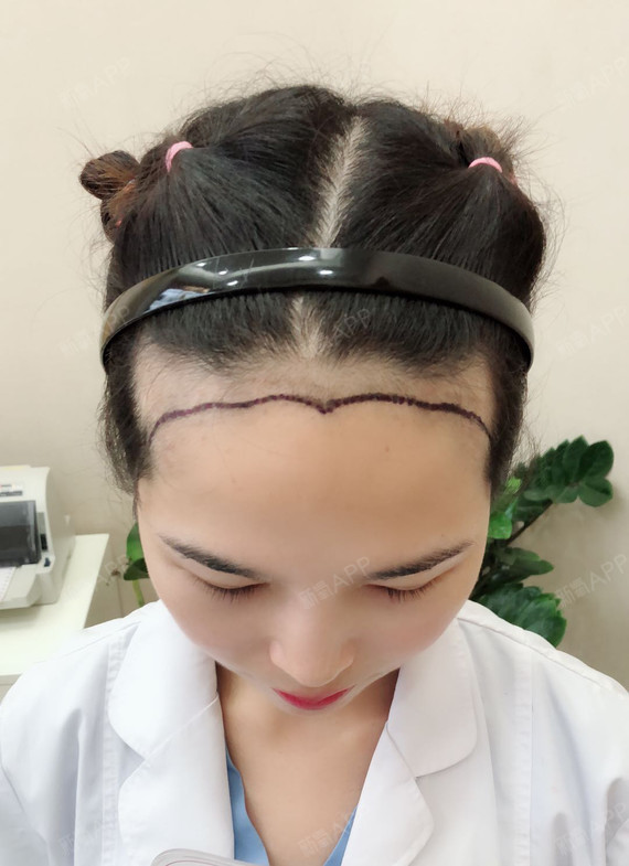 微笑的维密熊种植发际线第0天美丽日记-新氧美