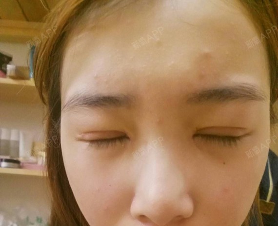 小秦子切开双眼皮第11天美丽日记-新氧美容整