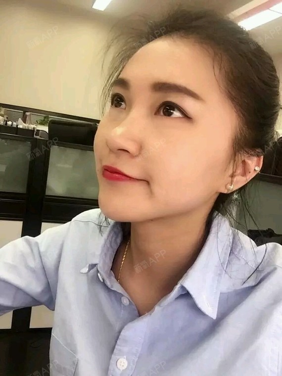 贫穷和富有激光去眼袋第10天美丽日记-新氧美