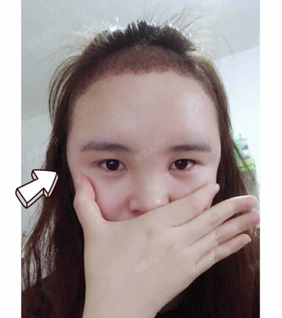 yi依依种植发际线第181天美丽日记-新氧美容整