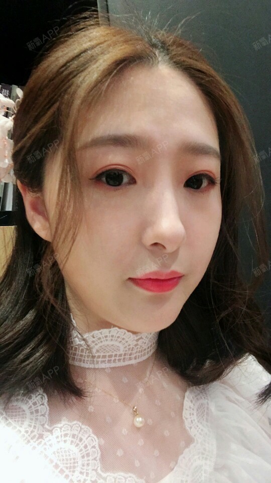 氧气3295461525859885玻尿酸垫下巴第23天