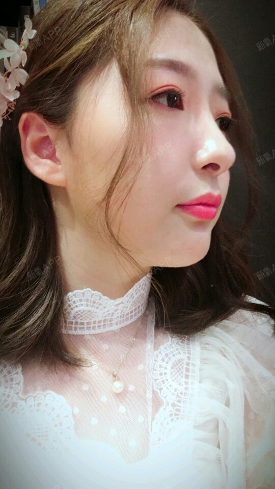 氧气3295461525859885玻尿酸垫下巴第23天