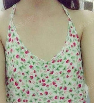 配齐保安假体隆胸第49天美丽日记-新氧美容整