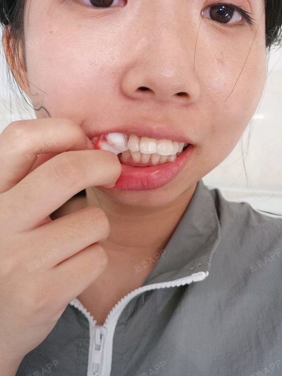 拔牙拍的图,都是原图没美颜,可能有点辣眼睛,不过为了让我以后可以