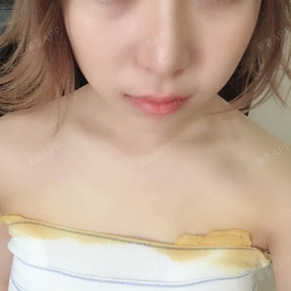 术后第7天,拆掉了一部分的线,剩下的还要再恢复,现_圈子-新氧美容整形