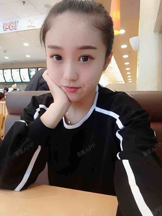 氧气1526751529817148激光去眼袋第14天美