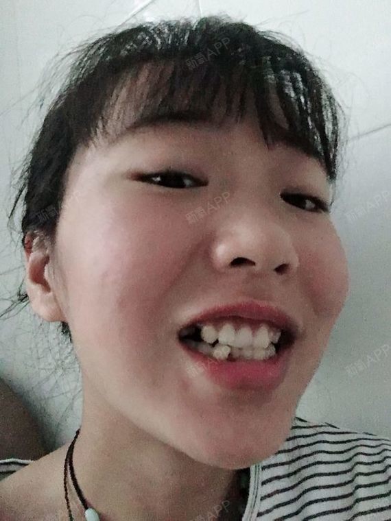 缺牙巴   