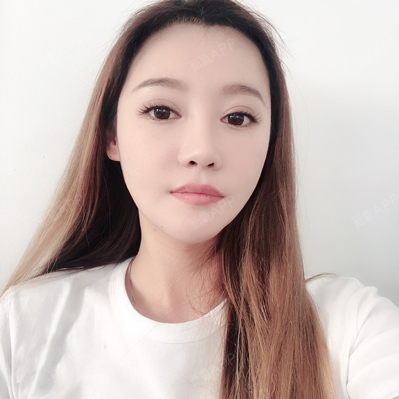 赵三金面部吸脂第116天美丽日记-新氧美容整形