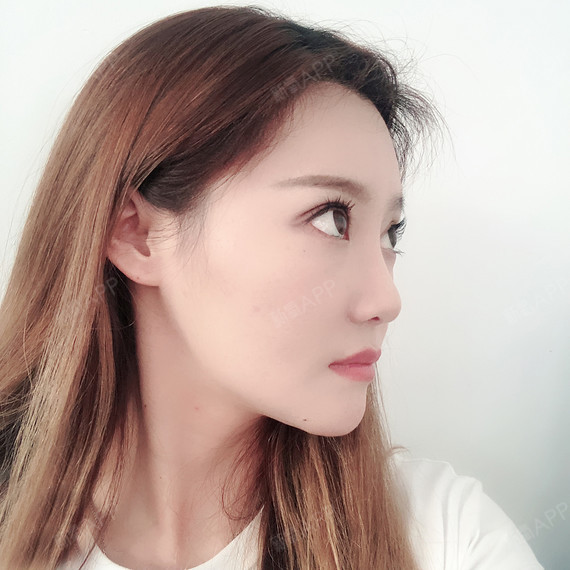 赵三金面部吸脂第116天美丽日记-新氧美容整形