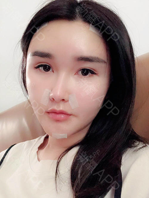 新氧 氧气3706611529555858 自体脂肪填充全脸 术后当自强