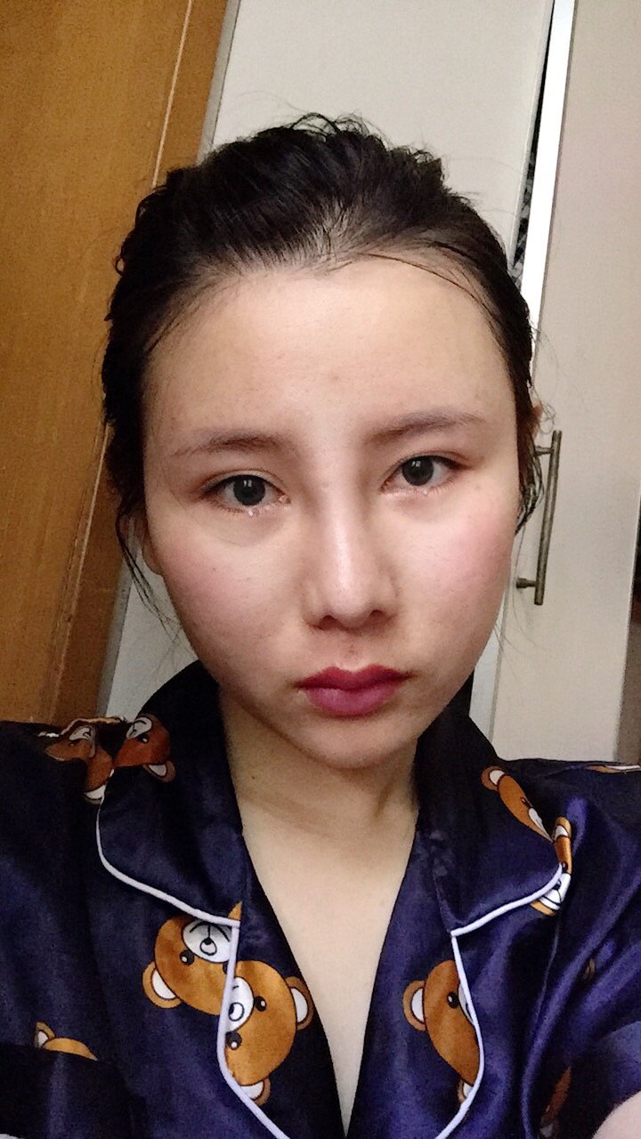下眼下至术第12天