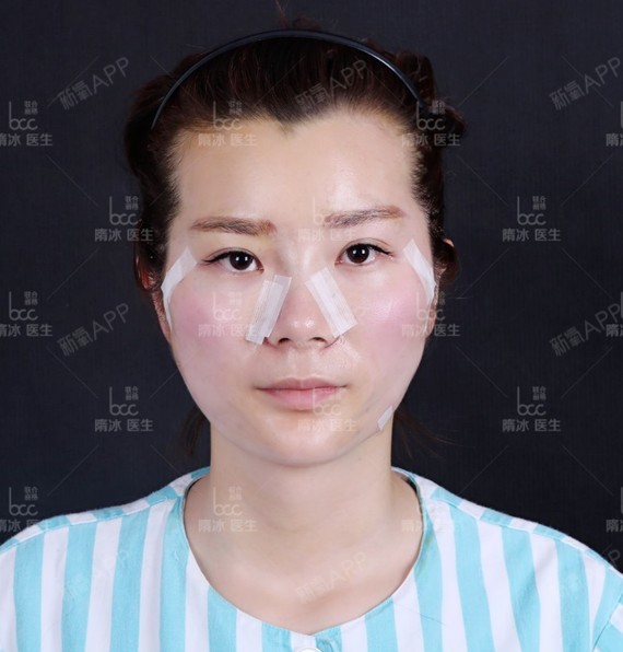 我不是聂小倩埋线提升第1天美丽日记-新氧美容