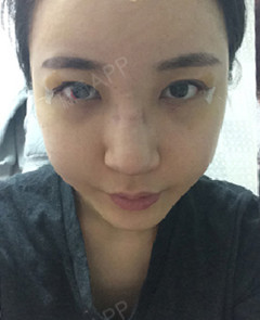 打呼噜的猩猩自体脂肪全脸填充第8天美丽日记