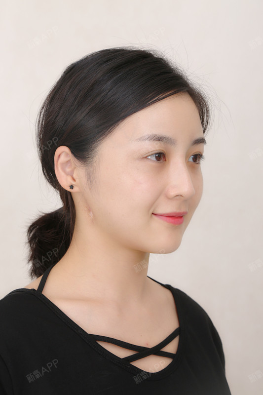 燕燕燕子自体脂肪丰面颊第122天美丽日记
