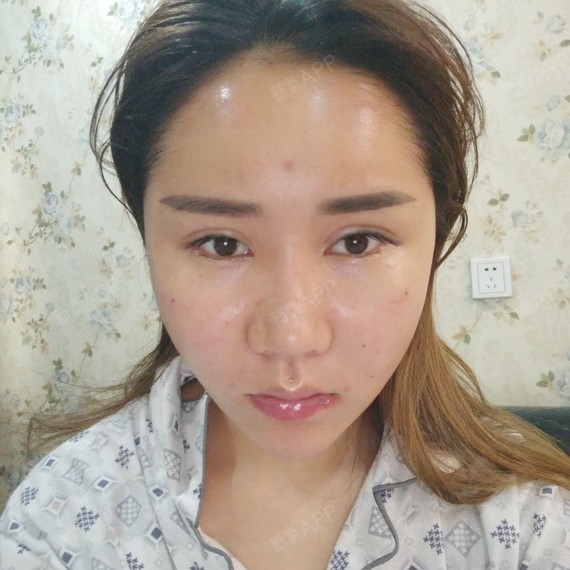 长头发的大脸妹p自体脂肪全脸填充第1天美丽