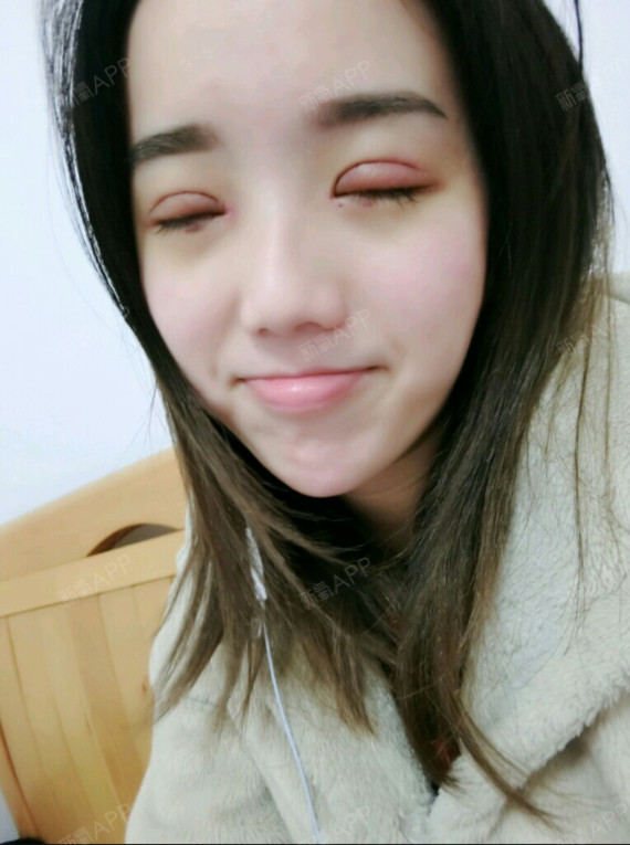 新氧- 采蘑菇的菇凉 | 眼部 | 开眼角 | 双眼皮 | 开外眼角 | 切开双