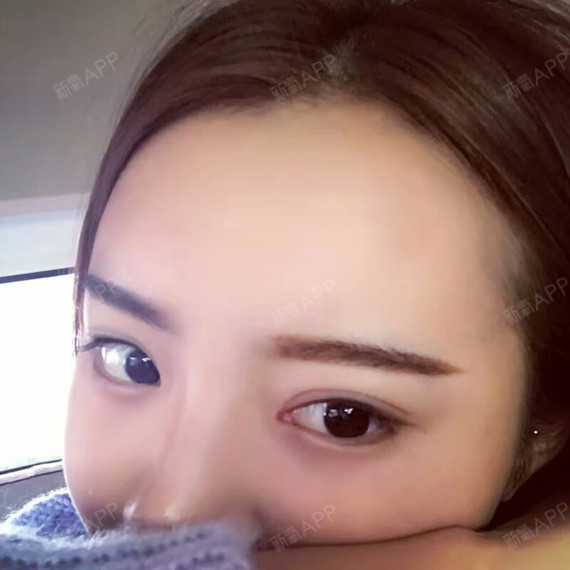 国但享国耍纳自体脂肪全脸填充第59天美丽日