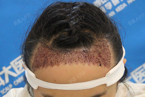 六月的尾巴628种植发际线第3天美丽日记-新氧