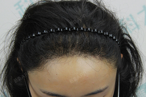 六月的尾巴628种植发际线第273天美丽日记-新