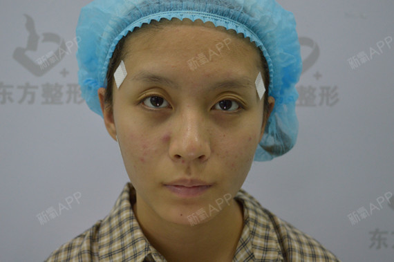 叶子147埋线提升第1天美丽日记-新氧美容整形