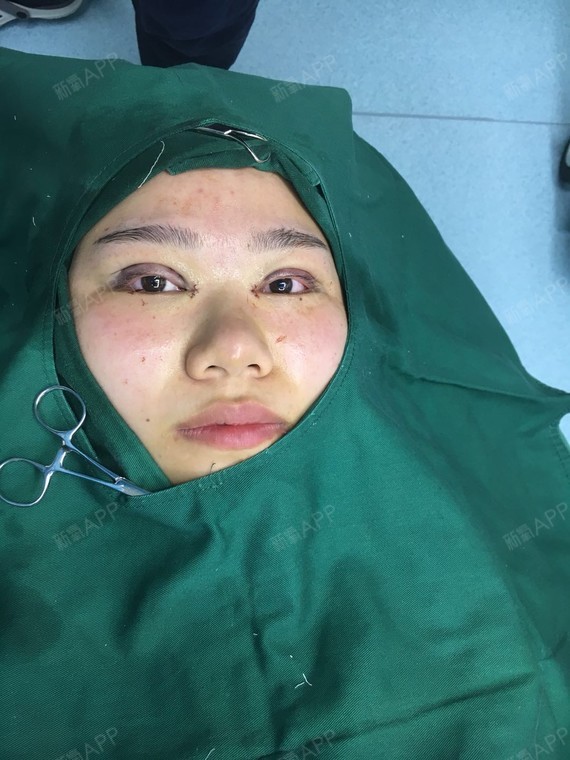 阿尔法的猫1开内眼角第0天美丽日记-新氧美容