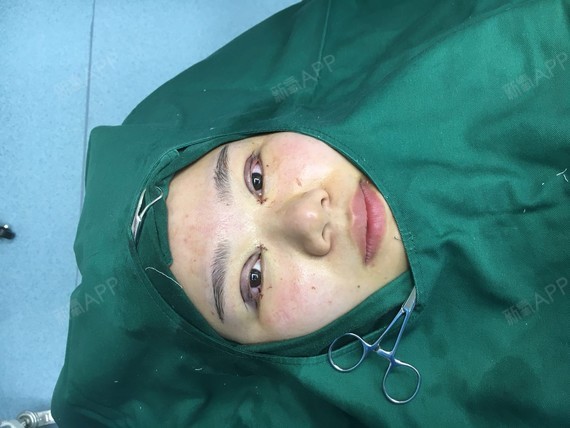 阿尔法的猫1开内眼角第0天美丽日记-新氧美容