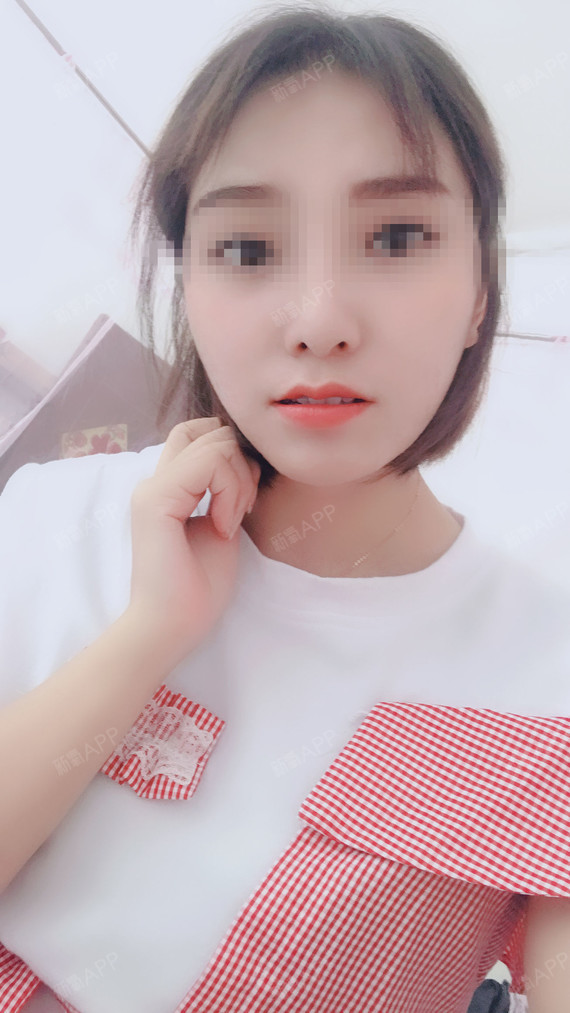 v-line瓜子脸手术