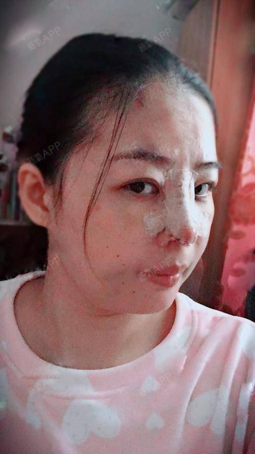 氧气8648021527329190硅胶隆鼻第3天美丽日